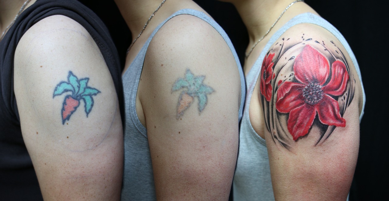 Best Tattoo Removal Hospital in Delhi  Primus Super Speciality Hospital